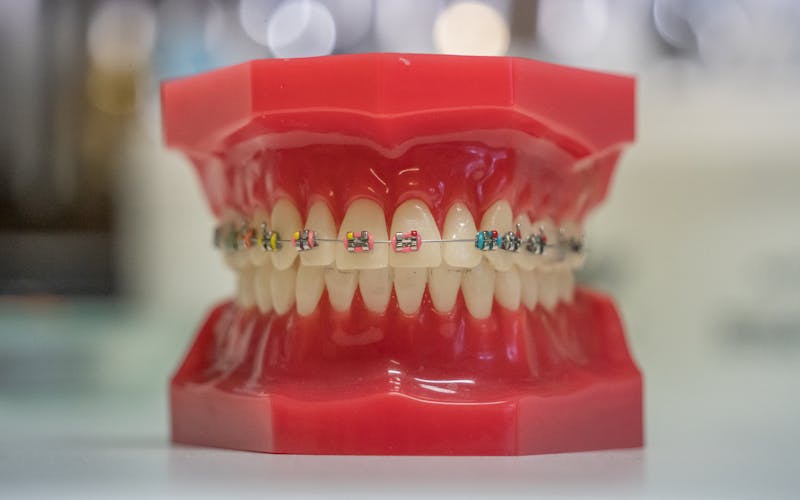 Aparatić za zube u Hrvatskoj 2026: vrste, cijene i HZZO prava