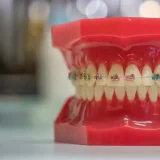 Braces in Croatia: types, costs, and HZZO rights