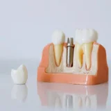 Dental implants in 2026: a patient guide